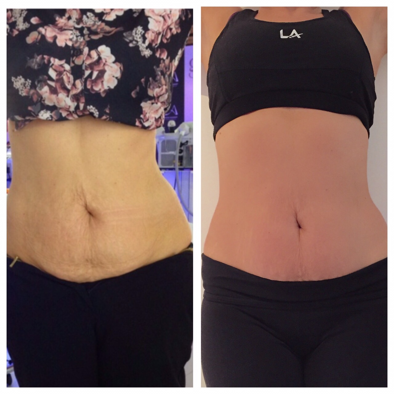 LipofirmPro Before and After 3 sessions_The Beautician